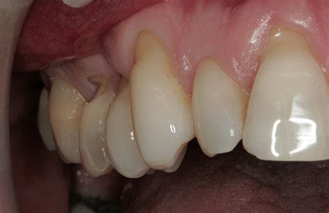 Tooth Abfraction Treatment