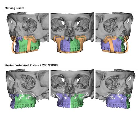 Surgical Planning for Maxillofacial Surgery - Airway & Sleep Group