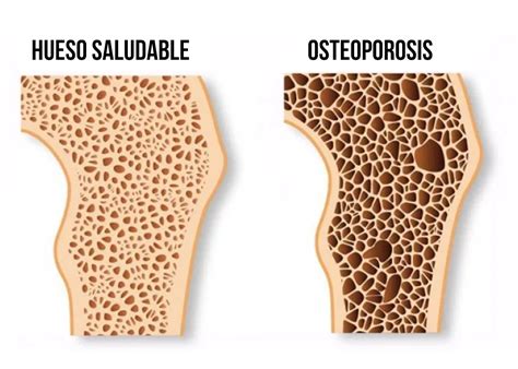 Osteoporosis Y Menopausia Síntomas Y Tratamiento