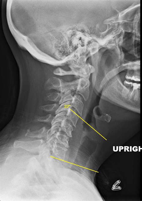 Cervical Degeneratinve Kyphosis | Cervical Spine | Denver Area