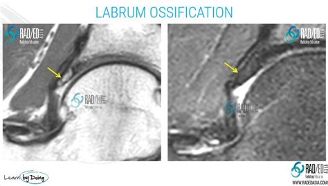 Hip Labrum Ossification Mri Labral Abnormalities More Than Just Tears