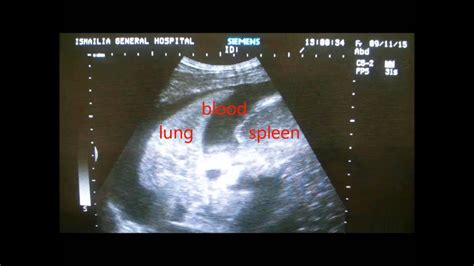 Hemothorax Ultrasound