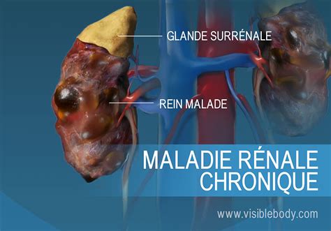 Pathologies du système urinaire