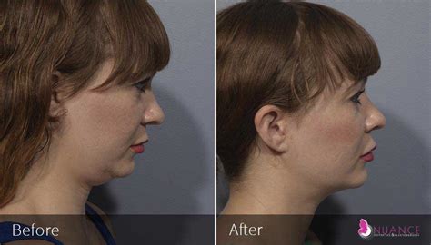 Neck Lift Surgery Las Vegas, NV | Plastic Surgeon in Las Vegas, NV