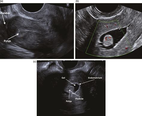 Uterus Cancer Ultrasound