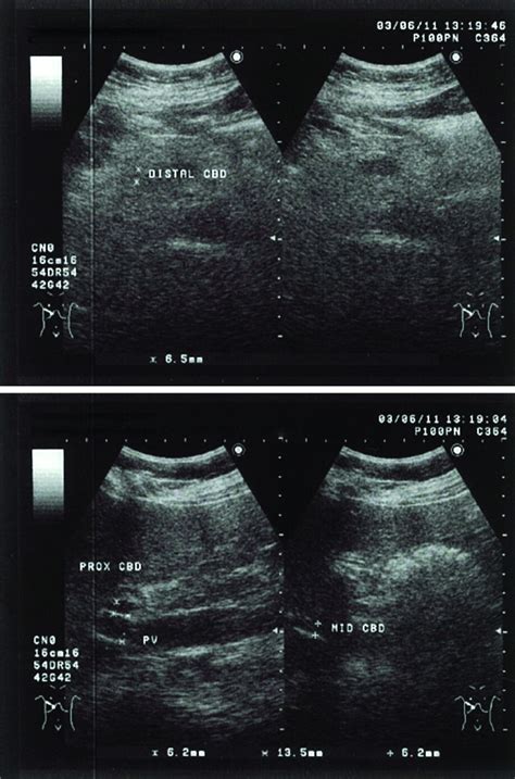 Ultrasonographic Measurement Of Normal Common Bile Duct Diameter And