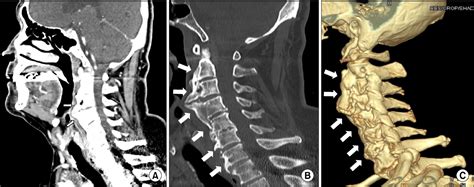 Figure From Early Detection Of Anterior Cervical Osteophytes Causing