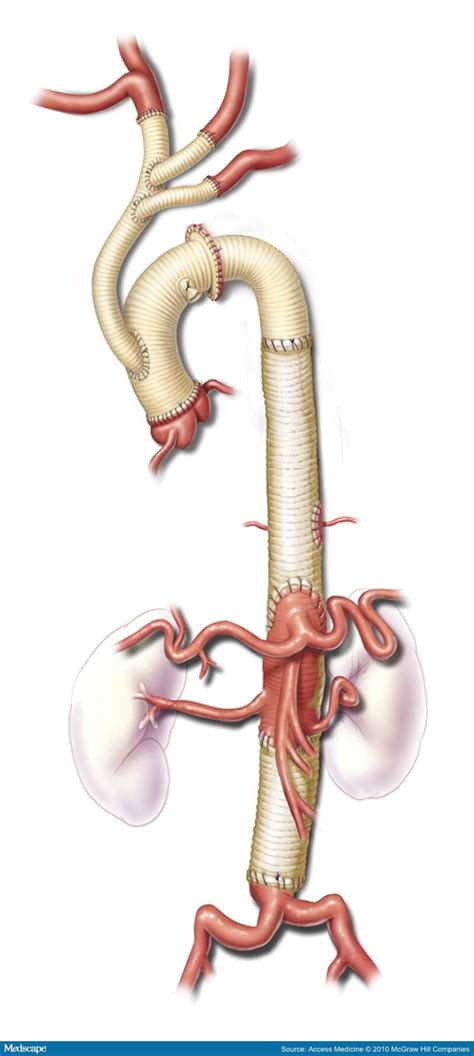 Aortic Dissections And Thoracic Aneurysms An Update