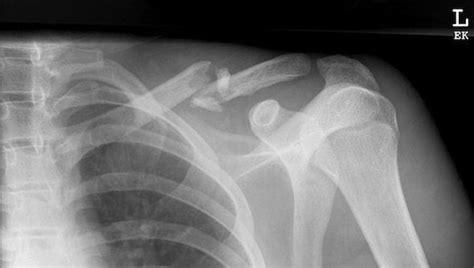 Clavicle fractures • LITFL • Trauma Library