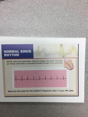 Rhythm Strips Flashcards Quizlet