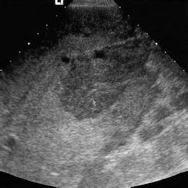 (PDF) Ultrasound‐guided percutaneous liver biopsy