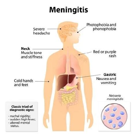 Meningitis Meaning Symptoms And Treatment