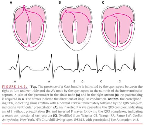 Introduction To Arrhythmias Thoracic Key