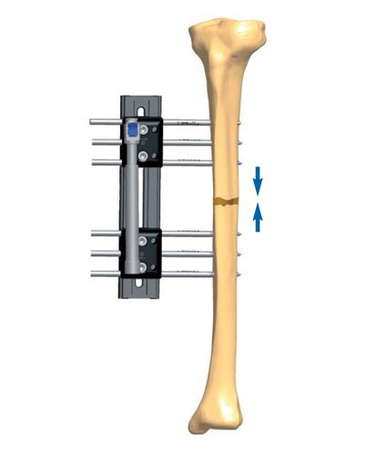 Tibial Non Union Treatment Orthofix Abs