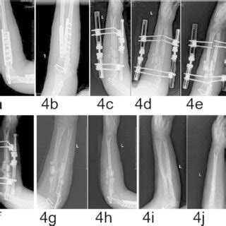 A 37 Year Old Male Patient With A Grade I IMSO A B AP And Lateral