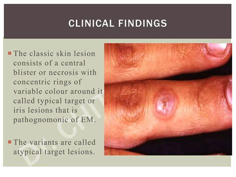 Erythema Multiforme Dr Chithra P Ppt