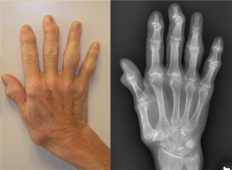 Hand Biomechanics Flashcards Quizlet