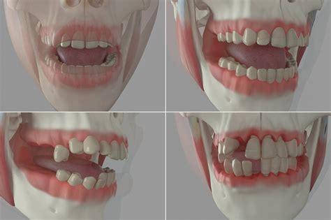 Dental 3d medical animation periodontal disease - Visualmedics Studio