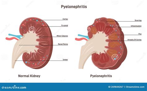 Pyelonephritis Kidney Infection Disease Inflammation Of Organ Tissue