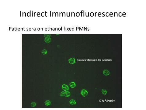 Ppt Anti Neutrophil Cytoplasmic Antibodies Anca Powerpoint