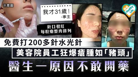 美容事故｜免費打逾200針水光針 美容院員工狂爆瘡腫如「豬頭」 醫生一原因不敢開藥 晴報 健康 皮膚護理 D231021