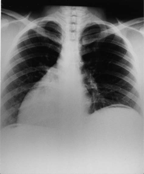 Chest Radiograph Demonstrates Dextrocardia With An Elevated Left