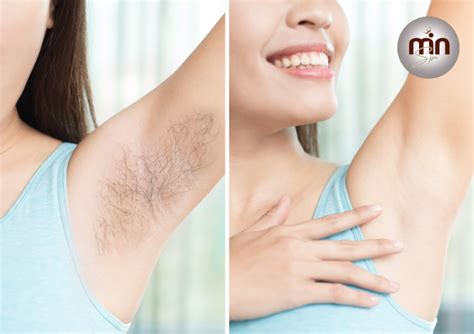 TRIỆT LÔNG BIKINI SAO CHO AN TOÀN HIỆU QUẢ