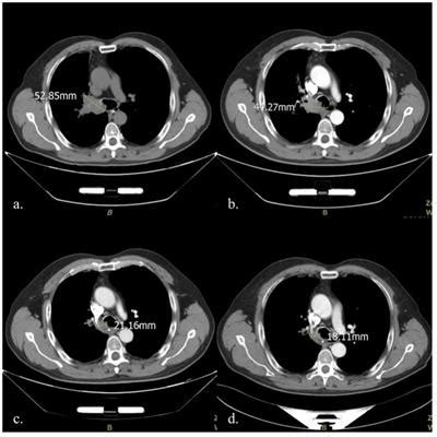 Frontiers Case Report Bronchial Artery Embolization And