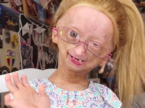 Adalia Rose La Joven Con Un Síndrome De Envejecimiento Prematuro Que