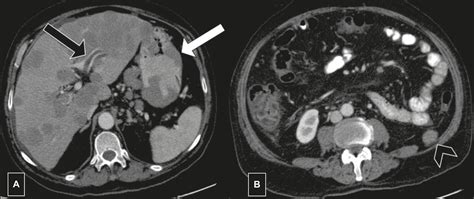 Scielo Brasil The Many Faces Of Primary And Secondary Hepatic