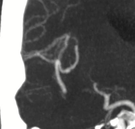 Ruptured M2 Pseudoaneurysm Pipeline Shield Embolization