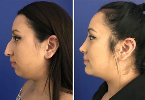 Revision Rhinoplasty Houston Texas Cilento Facial Plastics