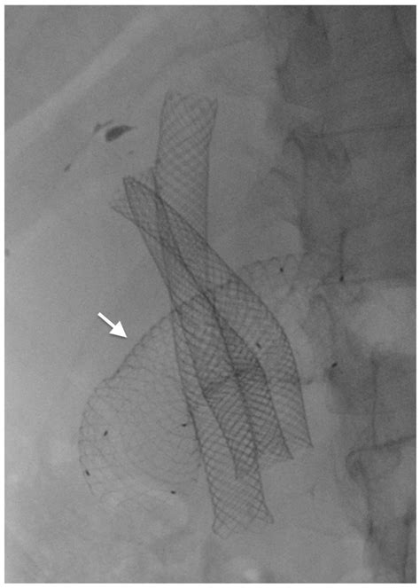 A duodenal uncovered metal stent (arrow) is placed to palliate a ...