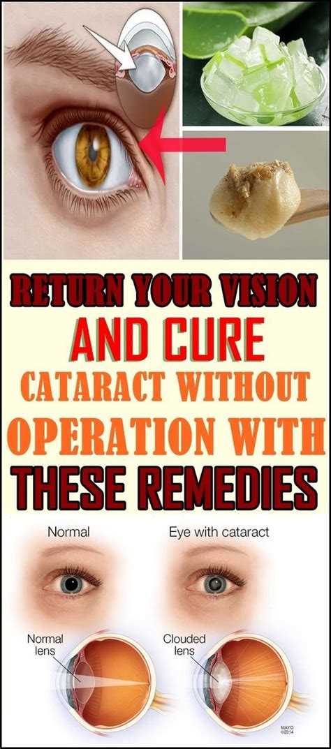 Cataract Surgery Headache Images Aboutheadache