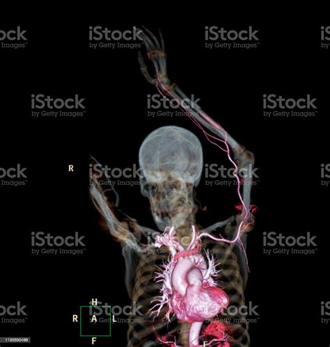 Arteri Brachial Cta Atau Ct Scan Ekstremitas Atas Atau Gambar Rendering