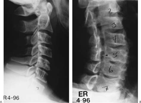 Cervical Root Compression | Musculoskeletal Key