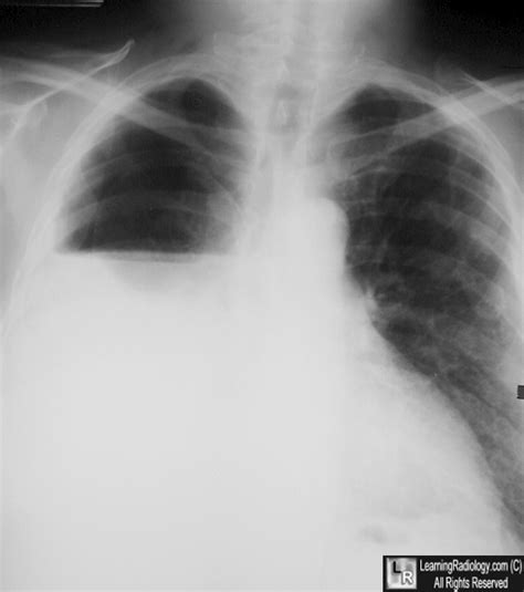 Learning Radiology Hydropneumothorax