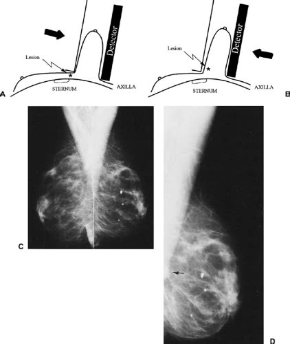 Mlo Mammography Positioning Angle