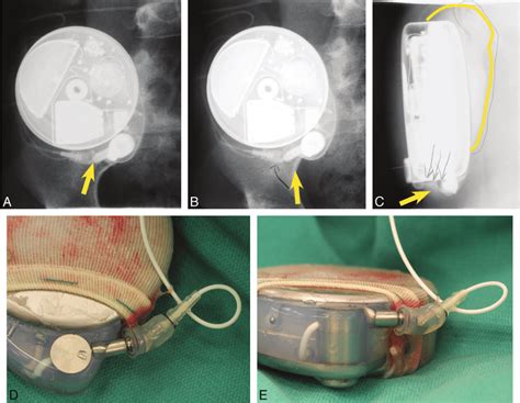 A Initial Fluoroscopic Spot Image A Demonstrating Disconnection At