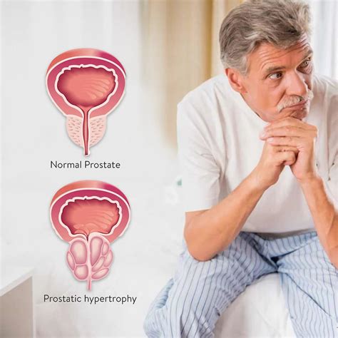 What Causes Prostate Enlargement And How To Manage It Lifezen