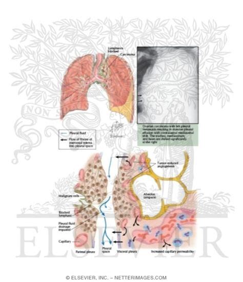 Malignancy In Pleural Effusion