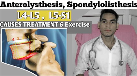 Anterolisthesis spondylolisthesis L5-s1, spondylolisthesis Treatment, Exercise Low back pain ...