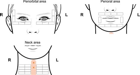 Treatment maps of the periorbital, perioral, and neck areas | Download ...