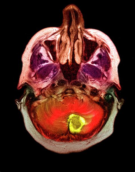 Haemangioblastoma Brain Tumour Photograph By Simon Fraser Science Photo