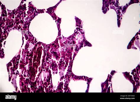 Histopathology Of Pneumonia Light Micrograph Photo Under Microscope