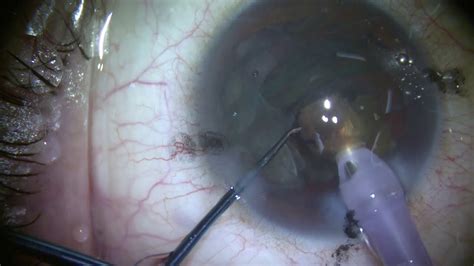 Dense Brunescent Cataract Surgery Flip And Chop Technique Youtube