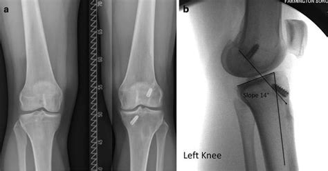 Two Stage Acl Revision Indications And Technique Plastic Surgery Key