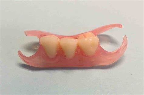 Partial Denture Dr Gentry