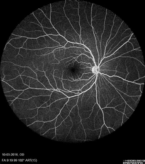 Normal Wide Field Fundus Fluorescein Angiography With Heidelberg