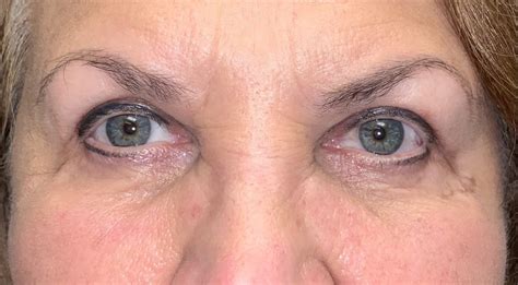 17 Upper Eyelid Surgery Before And After Photos Dallas Plano Texas Cosmetic Reconstructive